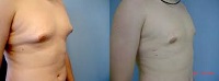 columbus male breast reduction