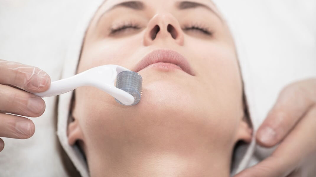 Microneedling, Microneedling in Columbus, Ohio