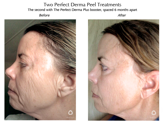 , Why we love The Perfect Derma Peel™