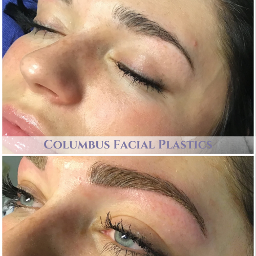 , Brow Lift Options in Columbus: Rejuvenate Your Upper Face