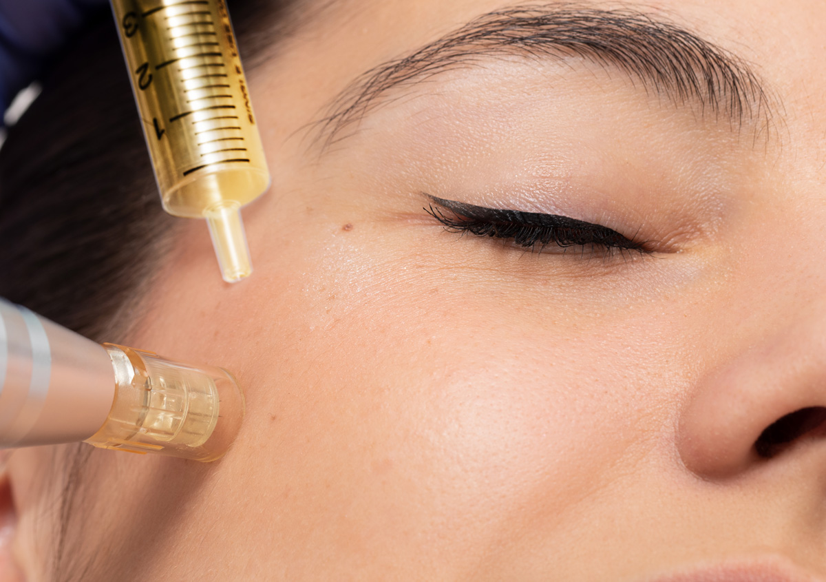 Microneedling, Microneedling in Columbus, Ohio