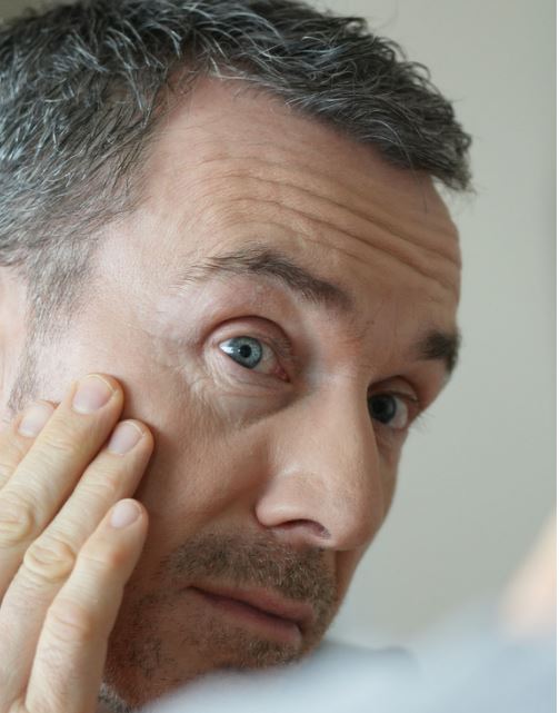 , Upper And Lower Eyelid Lift
