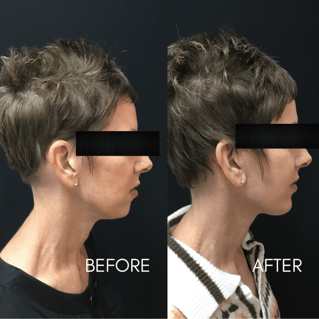 , Facelift in Columbus, Ohio