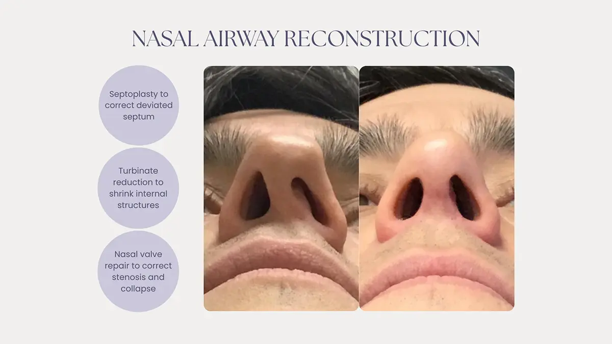 , Nasal Airway Surgery in Columbus