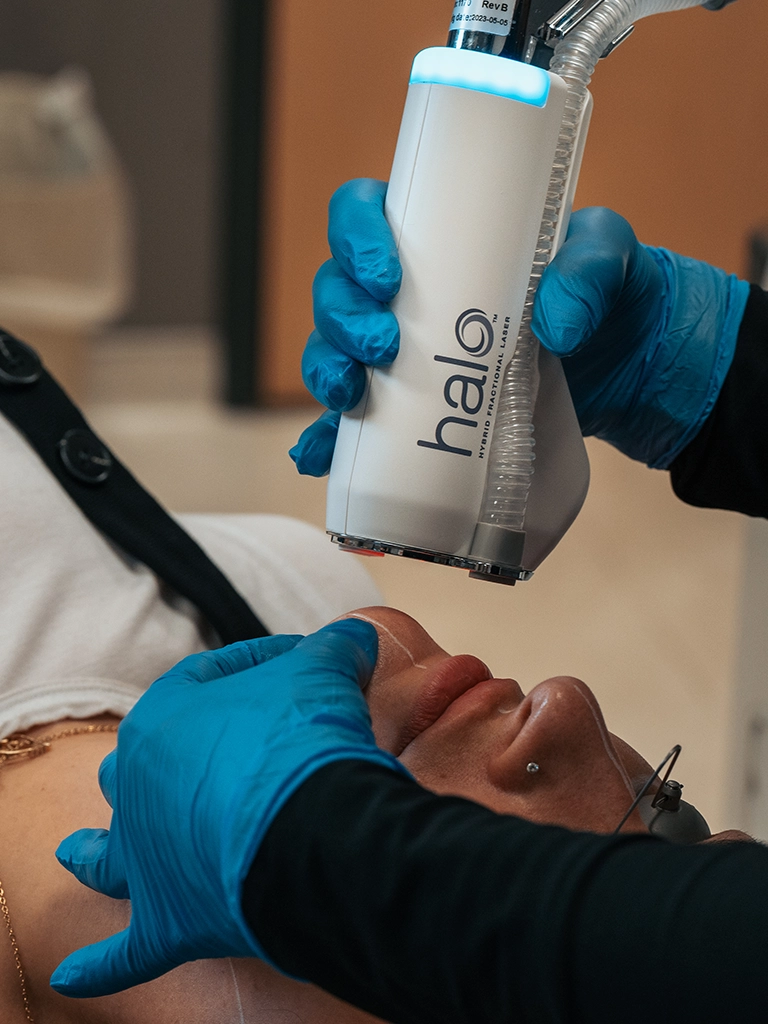 Broad Band Light (BBL), HALO Laser Treatment in Columbus, Ohio